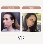 Результаты ринопластики до и после в VG Plastic Surgery, естественная коррекция носа