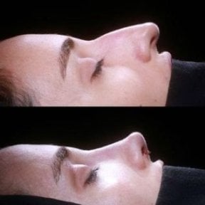Vorher-nachher-Ergebnis der Spitzenrhinoplastik in Medipol Acibadem District Hospital