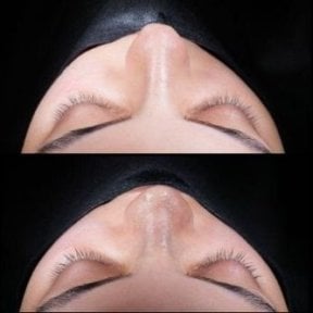 Vorher-nachher-Ergebnis der Spitzenrhinoplastik in Medipol Acibadem District Hospital