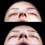 Vorher-nachher-Ergebnisse der Spitzenrhinoplastik in Medipol Acibadem District Hospital