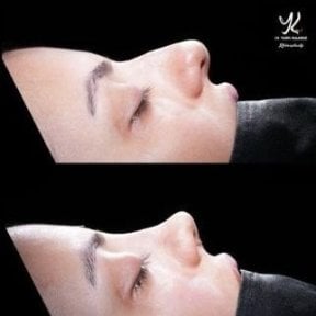Vorher-nachher-Ergebnis der Spitzenrhinoplastik in Medipol Acibadem District Hospital