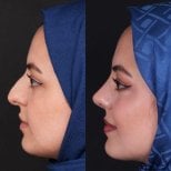 Vorher-nachher-Ergebnisse der Spitzenrhinoplastik in Medipol Acibadem District Hospital