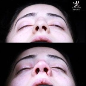 Vorher-nachher-Ergebnisse der Spitzenrhinoplastik in Medipol Acibadem District Hospital