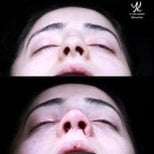 Vorher-nachher-Ergebnisse der Spitzenrhinoplastik in Medipol Acibadem District Hospital