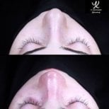 Vorher-nachher-Ergebnisse der Spitzenrhinoplastik in Medipol Acibadem District Hospital