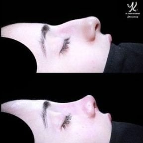 Vorher-nachher-Ergebnis der Spitzenrhinoplastik in Medipol Acibadem District Hospital