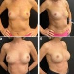 Before and after breast augmentation results at Memorial Bahçelievler Hospital, fuller breasts