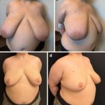 Before and after breast lift results at Memorial Bahçelievler Hospital, improved breast contour