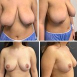 Before and after breast lift results at Memorial Bahçelievler Hospital, improved breast contour