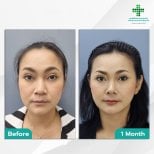 Fox Eye Lift before and after results at Intrarat Hospital, visible eyelid and brow lift effect