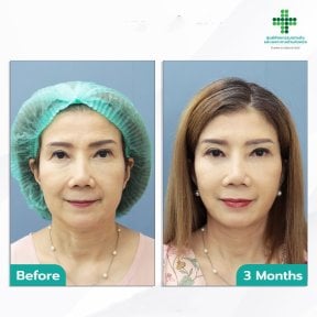 Fox Eye Lift before and after results at Intrarat Hospital, visible eyelid lift after 3 months