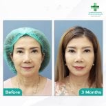 Fox Eye Lift before and after results at Intrarat Hospital, visible eyelid lift after 3 months