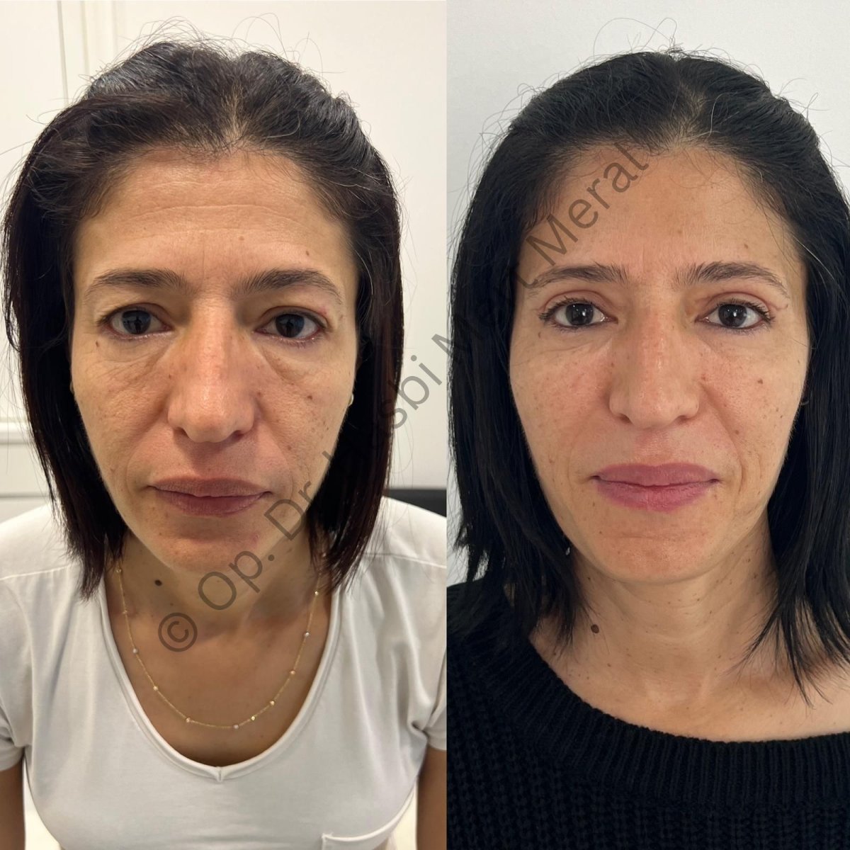 Resultados de lifting facial antes y después en la clínica – rejuvenecimiento visible
