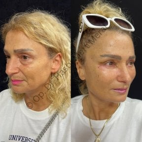 Результаты до и после подтяжки лица в клинике доктора Хасби Мерати, омоложение лица