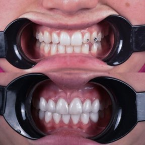 Before and after veneers result at Dentavie Istanbul Dental Clinic, smile makeover visible