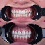 Before and after veneers result at Dentavie Istanbul Dental Clinic, smile makeover visible