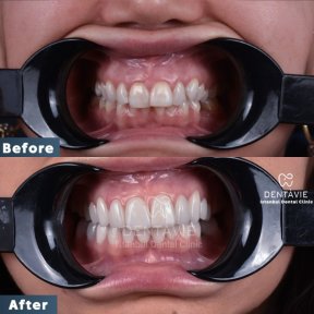 Before and after veneers result at Dentavie Istanbul Dental Clinic – smile transformation