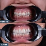 Before and after veneers result at Dentavie Istanbul Dental Clinic – smile transformation