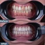 Before and after veneers results at Dentavie Istanbul Dental Clinic, smile transformation
