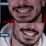 Before and after veneers result at Dentavie Istanbul Dental Clinic, improved smile aesthetics