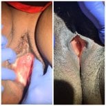 Résultats avant et après rajeunissement vaginal au laser à la clinique Esra Özbaşlı OBGYN