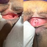 Résultats avant/après rajeunissement vaginal au laser à la clinique Dr Esra Özbaşlı