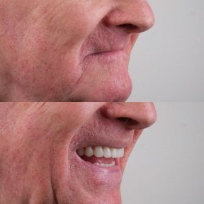 Before and after All-on-4 dental implants result at About Tooth Dental Clinic, improved smile