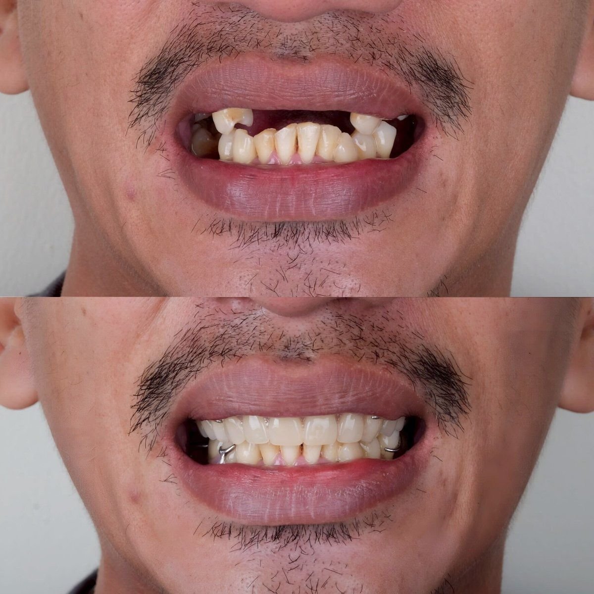 Resultado antes y después de implantes All-on-4 en About Tooth Dental Clinic, sonrisa mejorada