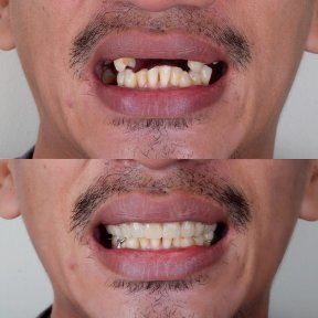 Before and after All-on-4 dental implants result at About Tooth Dental Clinic, improved smile