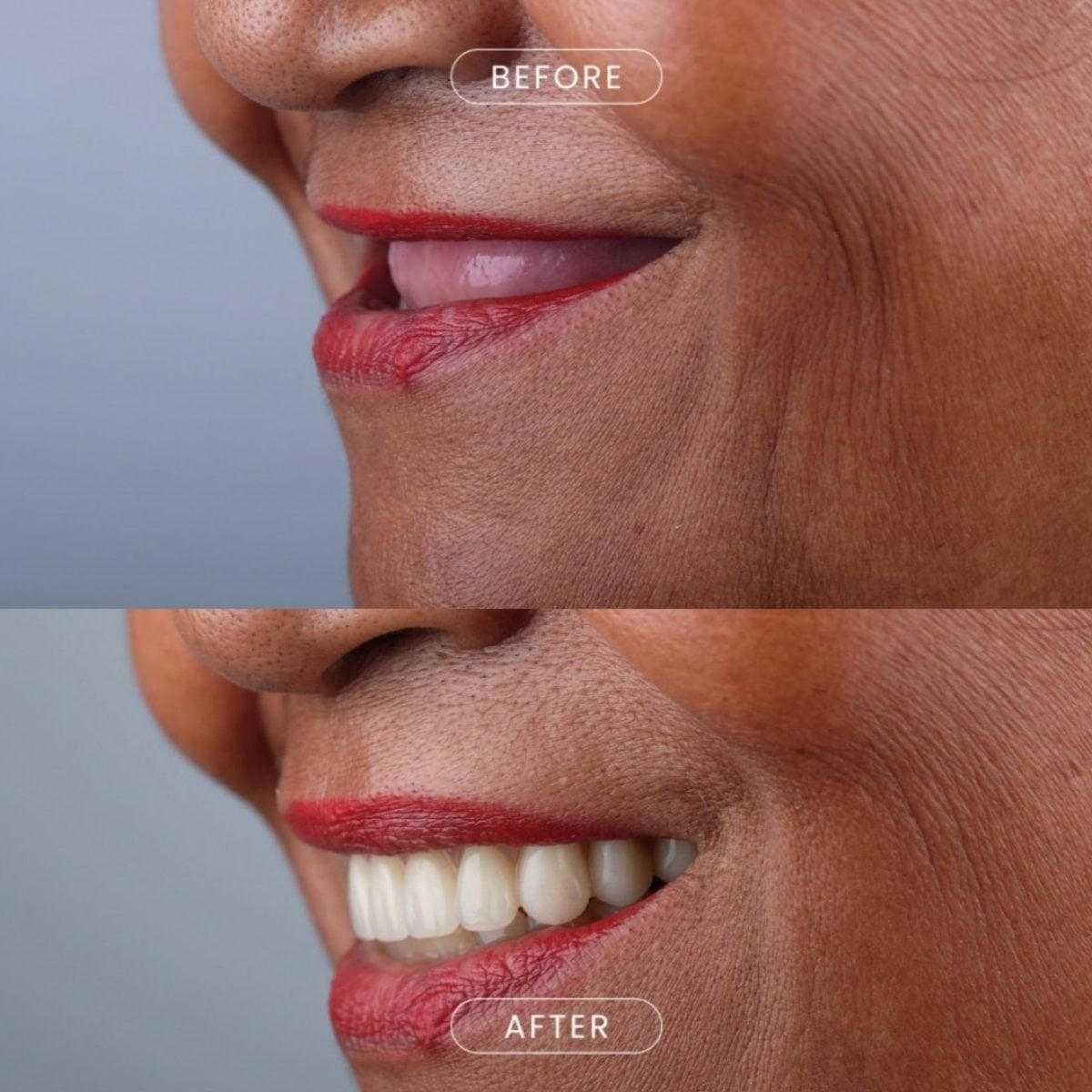 Resultado antes y después de implantes dentales All-on-4 en About Tooth Dental Clinic, sonrisa restaurada