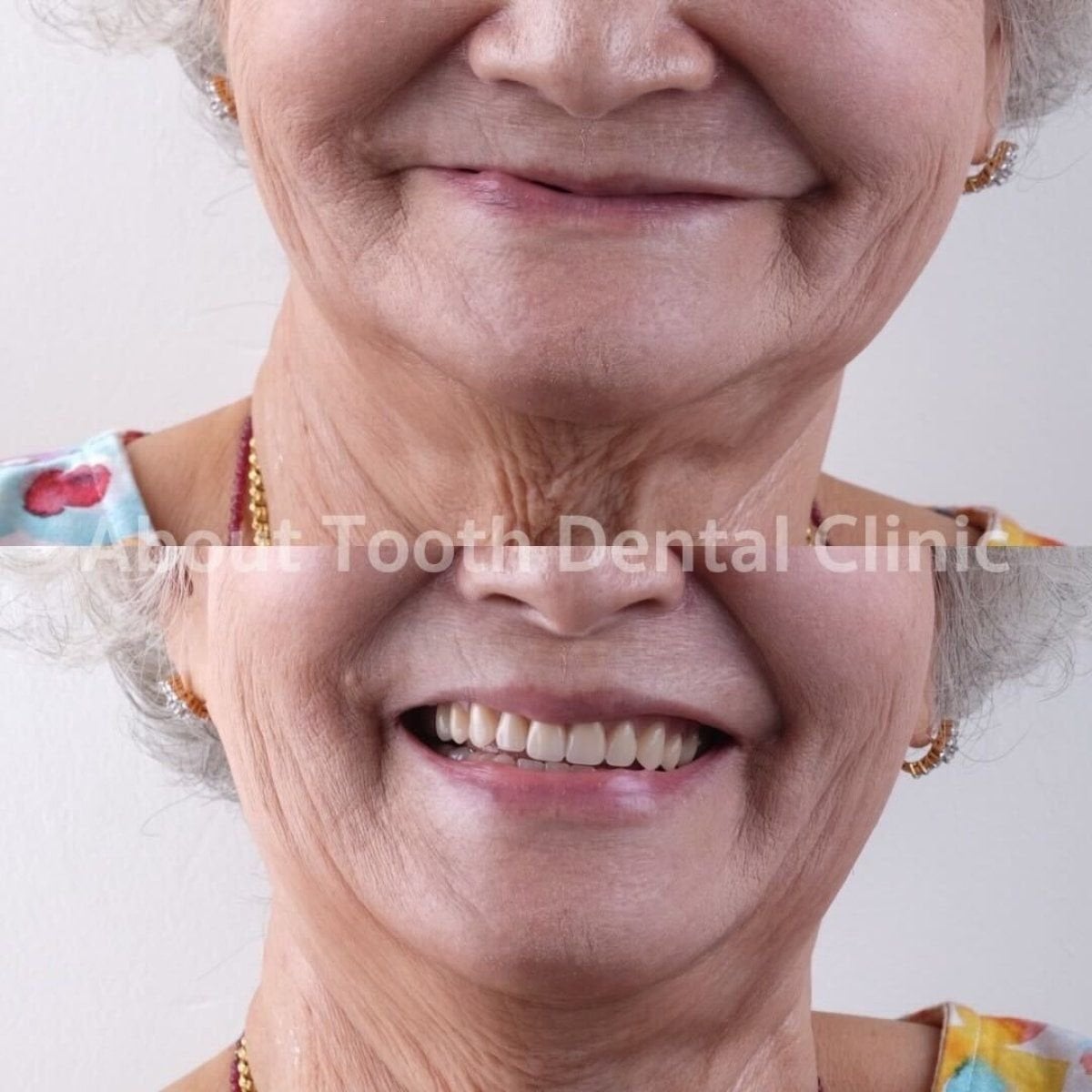 نتيجة قبل وبعد زراعة الأسنان All-on-4 في About Tooth Dental Clinic، ابتسامة محسنة