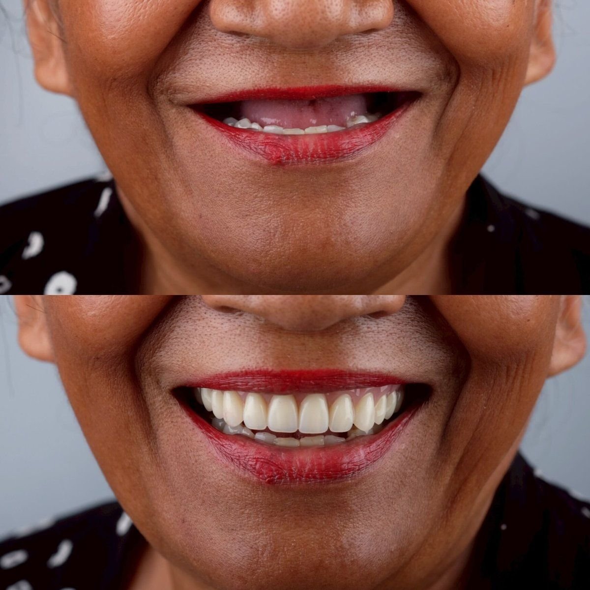 Resultados antes y después de implantes All-on-4 en About Tooth Dental Clinic, restauración de sonrisa