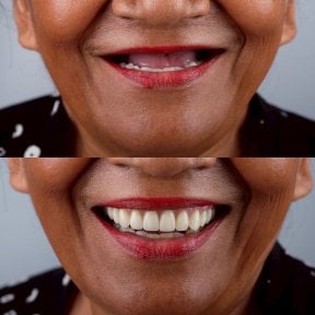 Efekt przed i po implantach All-on-4 w About Tooth Dental Clinic, odbudowa uśmiechu