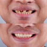 Efekt przed i po implantach All-on-4 w About Tooth Dental Clinic, poprawiony uśmiech