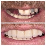Zdjęcia przed i po Implantacja zębów All-on-4 w jeden dzień wykonane przez dr. 