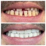 Zdjęcia przed i po Implantacja zębów All-on-4 w jeden dzień wykonane przez dr. 