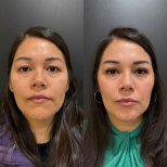 Vorher-nachher-Ergebnis Oberlidstraffung bei Dr. Alexandro Aguilera - Plastic Surgery