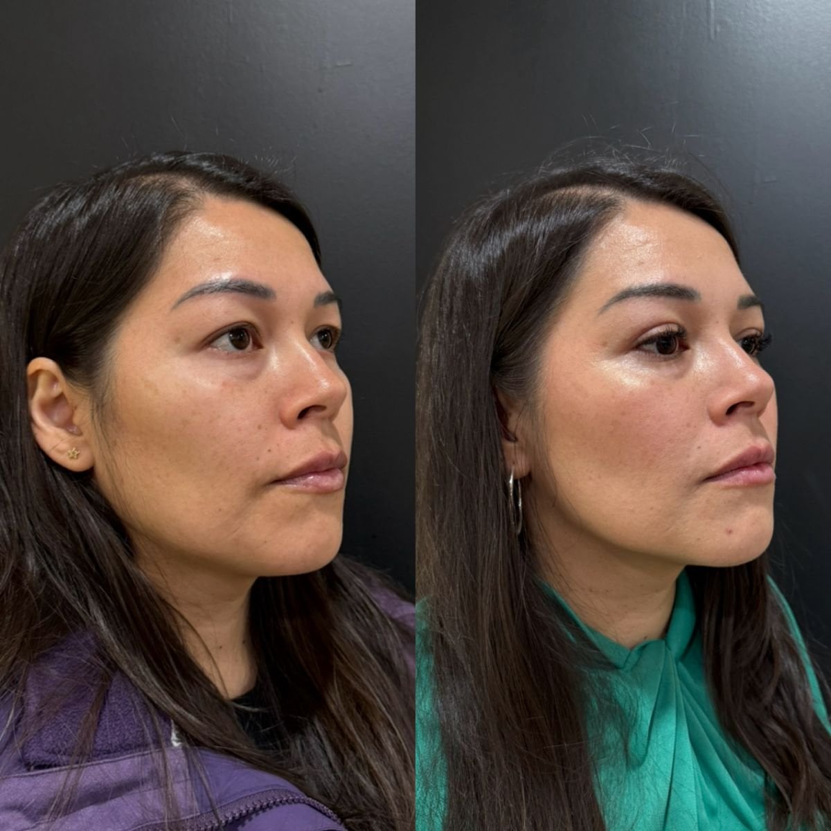 نتائج جراحة الجفن العلوي قبل وبعد في عيادة Dr. Alexandro Aguilera - Plastic Surgery