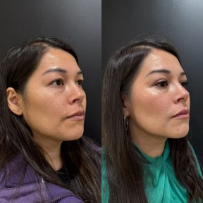 Vorher-nachher-Ergebnis Oberlidstraffung bei Dr. Alexandro Aguilera - Plastic Surgery