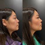Vorher-nachher-Ergebnis Oberlidstraffung bei Dr. Alexandro Aguilera - Plastic Surgery