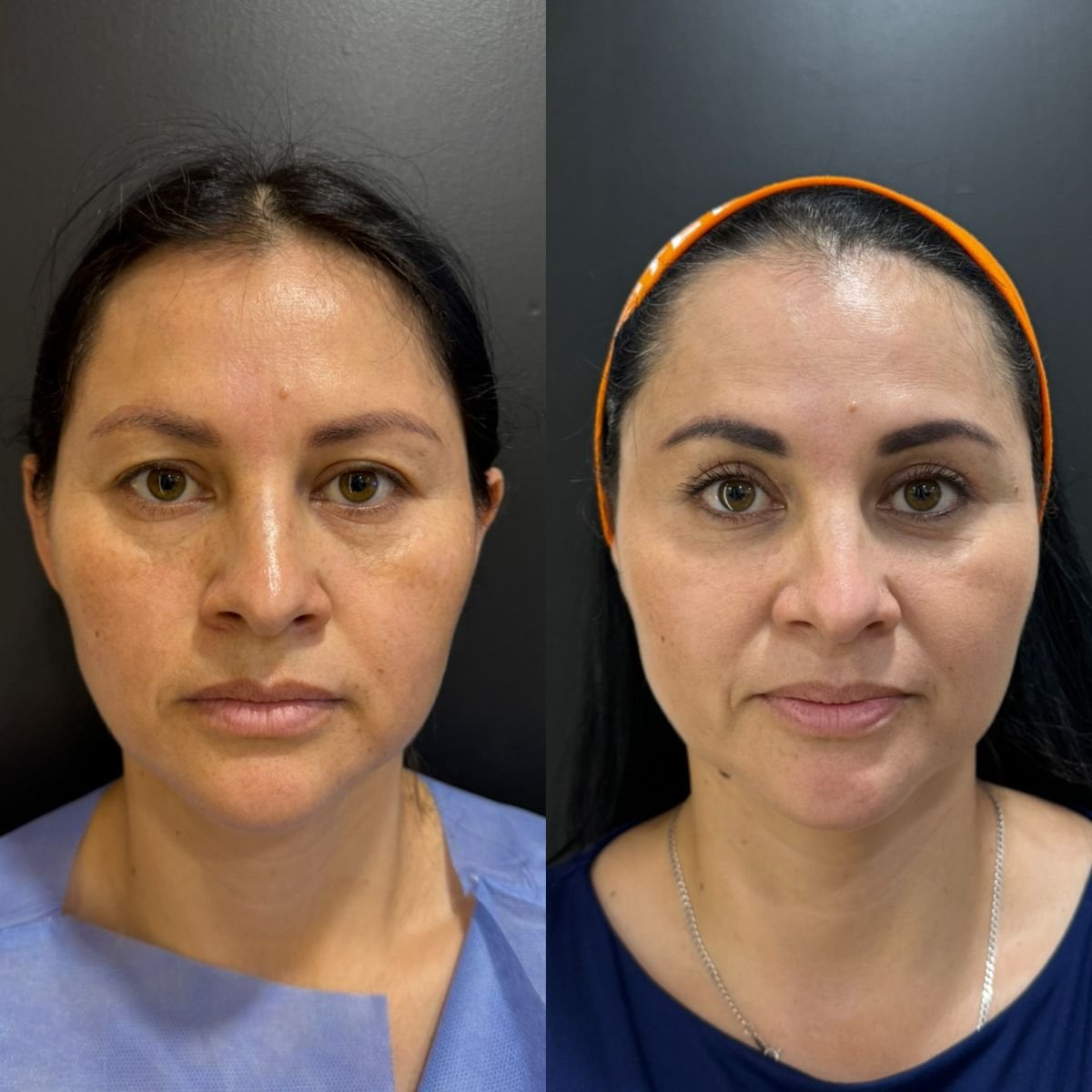 نتائج شد الجفن العلوي قبل وبعد في عيادة Dr. Alexandro Aguilera - Plastic Surgery