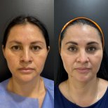 Vorher-nachher-Ergebnis Oberlidstraffung bei Dr. Alexandro Aguilera - Plastic Surgery