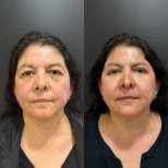 Vorher-nachher-Ergebnis Oberlidstraffung bei Dr. Alexandro Aguilera - Plastic Surgery