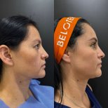 Vorher-nachher-Ergebnis Oberlidstraffung bei Dr. Alexandro Aguilera - Plastic Surgery