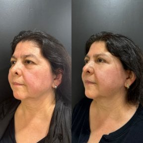 Vorher-nachher-Ergebnis Oberlidstraffung bei Dr. Alexandro Aguilera - Plastic Surgery