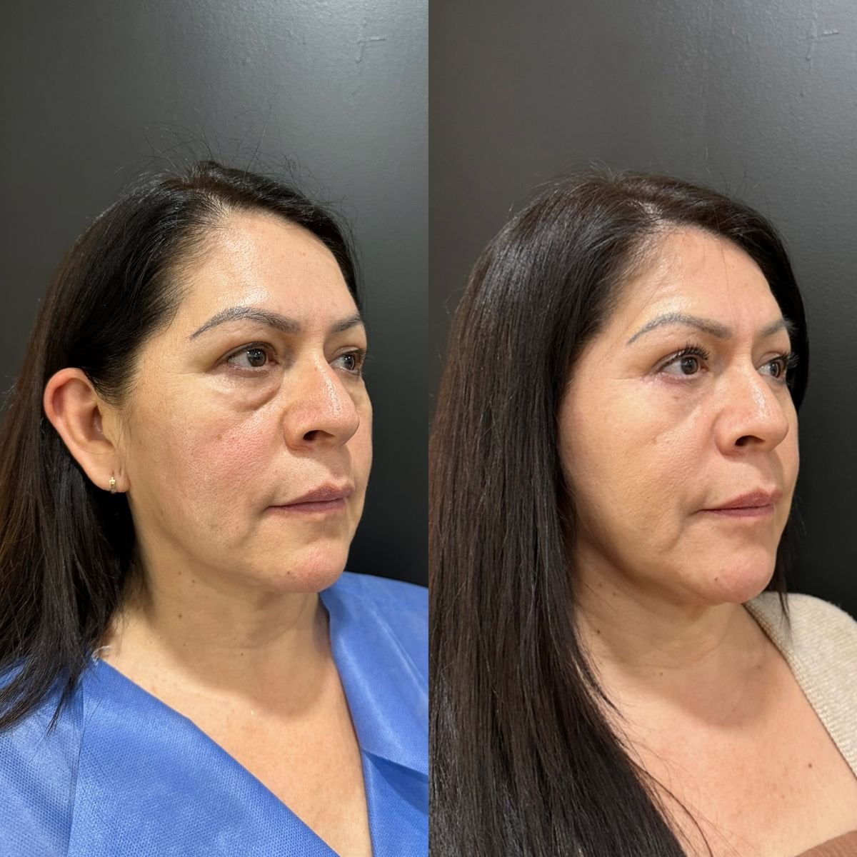 Before and after upper eyelid surgery results at Dr. Alexandro Aguilera - Plastic Surgery clinic