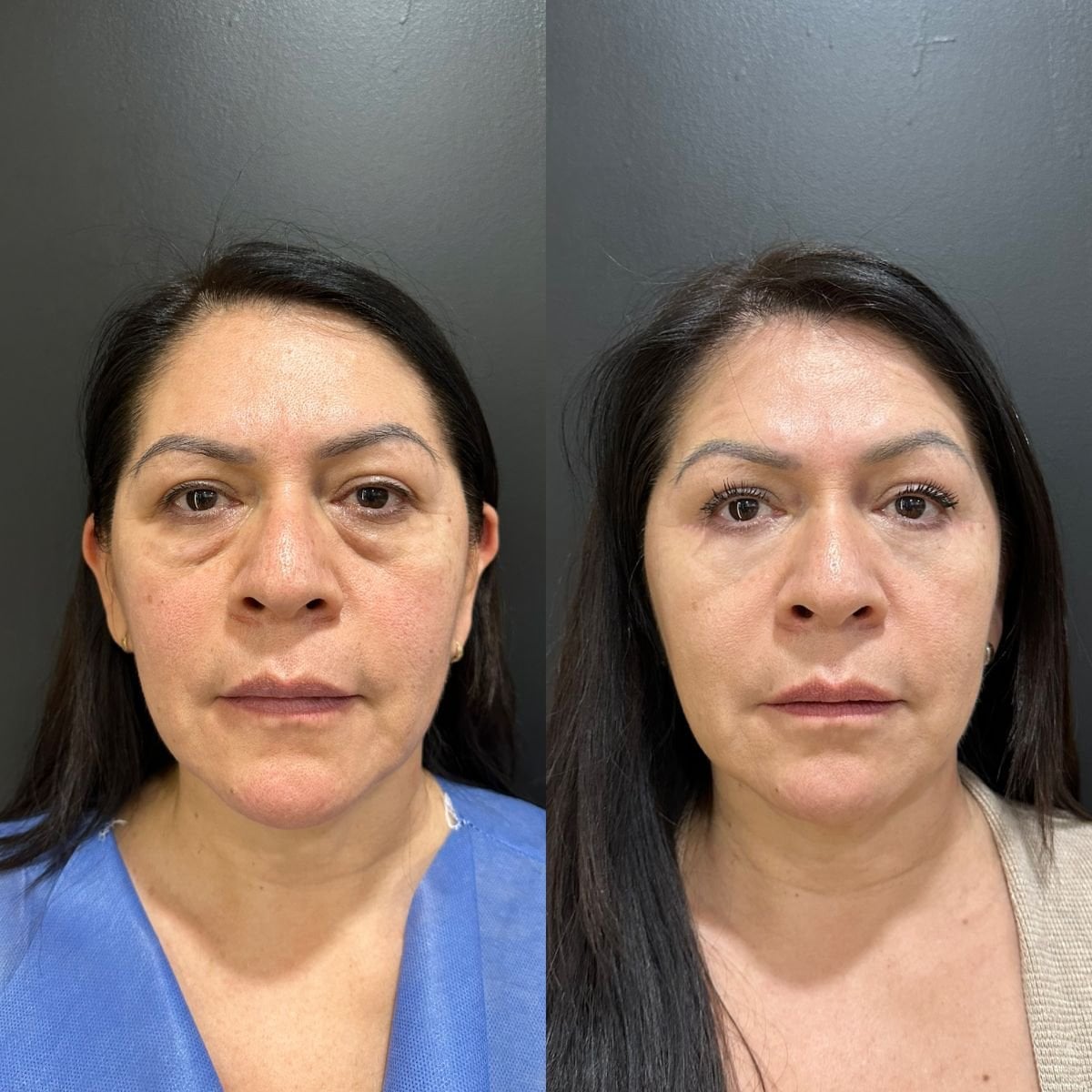 نتائج شد الجفن العلوي قبل وبعد في عيادة Dr. Alexandro Aguilera - Plastic Surgery