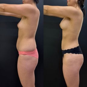 Vorher-nachher-Ergebnisse Brazilian Butt Lift bei Dr. Alexandro Aguilera - Plastic Surgery