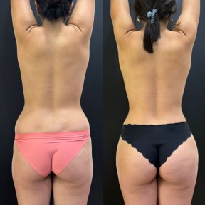 Vorher-nachher-Ergebnis Brazilian Butt Lift bei Dr. Alexandro Aguilera - Plastic Surgery