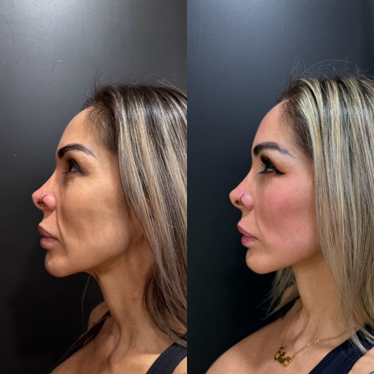 Facelift results at Dr. Alexandro Aguilera - Plastic Surgery
